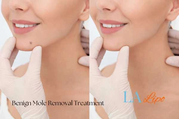 Before-and-after results following benign mole-removal treatment Virginia Water