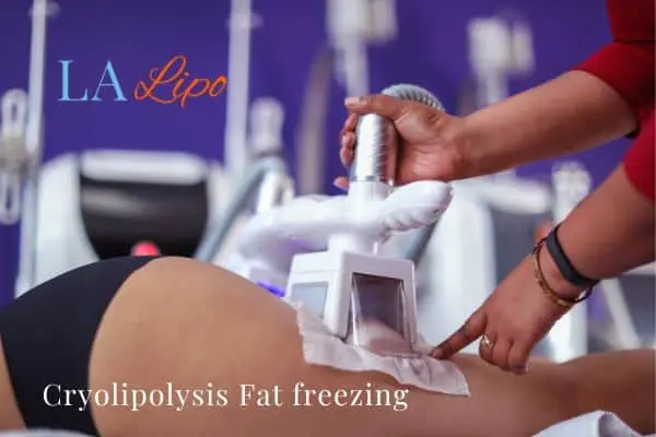 women getting fat freezing Virginia Water