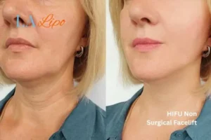 hi-fu for wrinkles Virginia Water before and after results