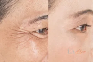 Before and after results of woman - HI-fu wrinkles reduction treatment Virginia Water