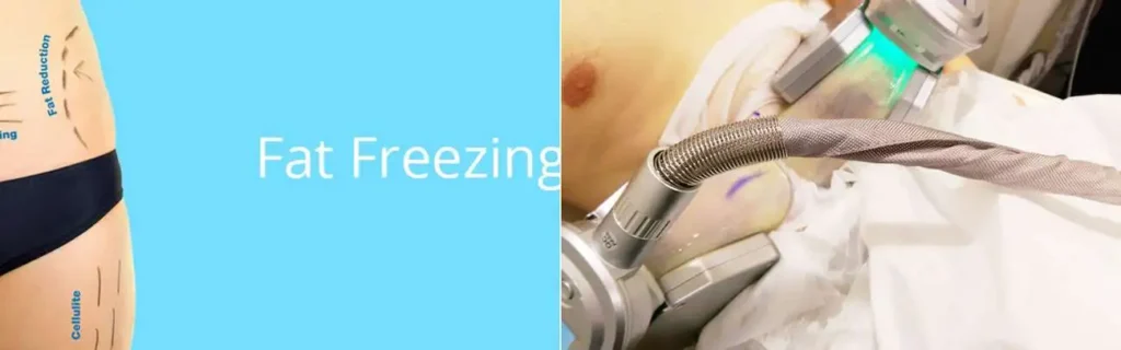 Fat freezing Virginia Water on multiple areas of the body