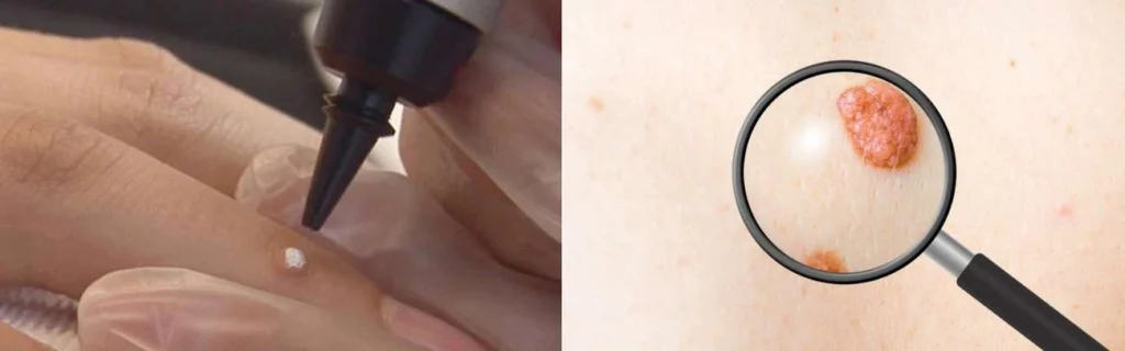 CryoPen practitioner Virginia Water assessing a benign mole before treatment