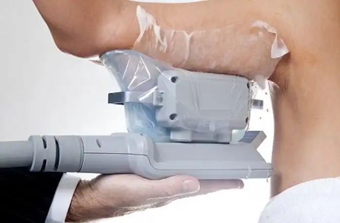 Picture of fat freezing Virginia Water on the upper arms.
