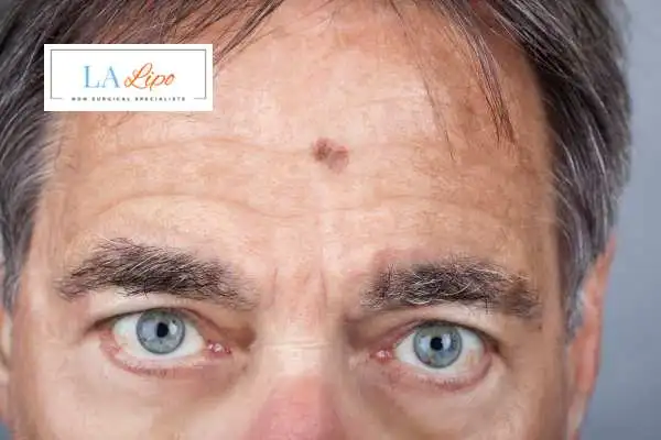 Solar Lentigo Removal Virginia Water image of man with mark on his forehead