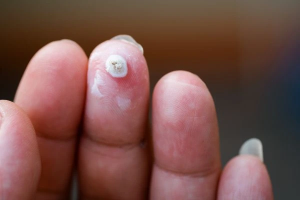 wart on person finger - cryotherapy to treat from LA LIPO Virginia Water