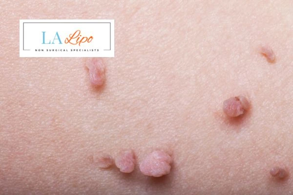 Does cryopen skin tag removal Virginia Water hurt? Find out now call our team today!
