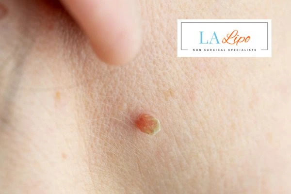 Book skin tag removal Virginia Water today speak to our team now!