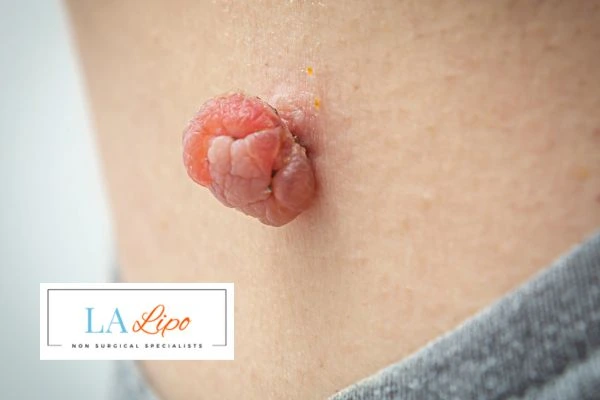 Interested in skin tag removal Virginia Water? Concerned about the pain? Find out more today!