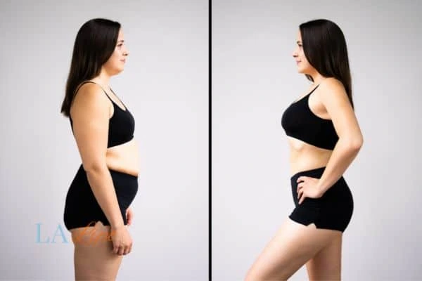 Picture of womans before and after using LA-EMS body sculpting to improve her core strength Virginia Water