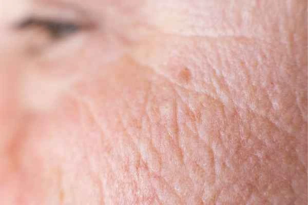 close up picture of a woman's face showing an age spot Virginia Water