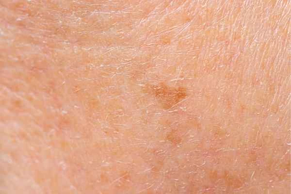 close up picture of age spots Virginia Water