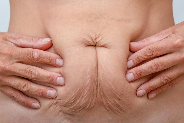 Image of a woman's stomach with loose skin - example of skin tightening Virginia Water options